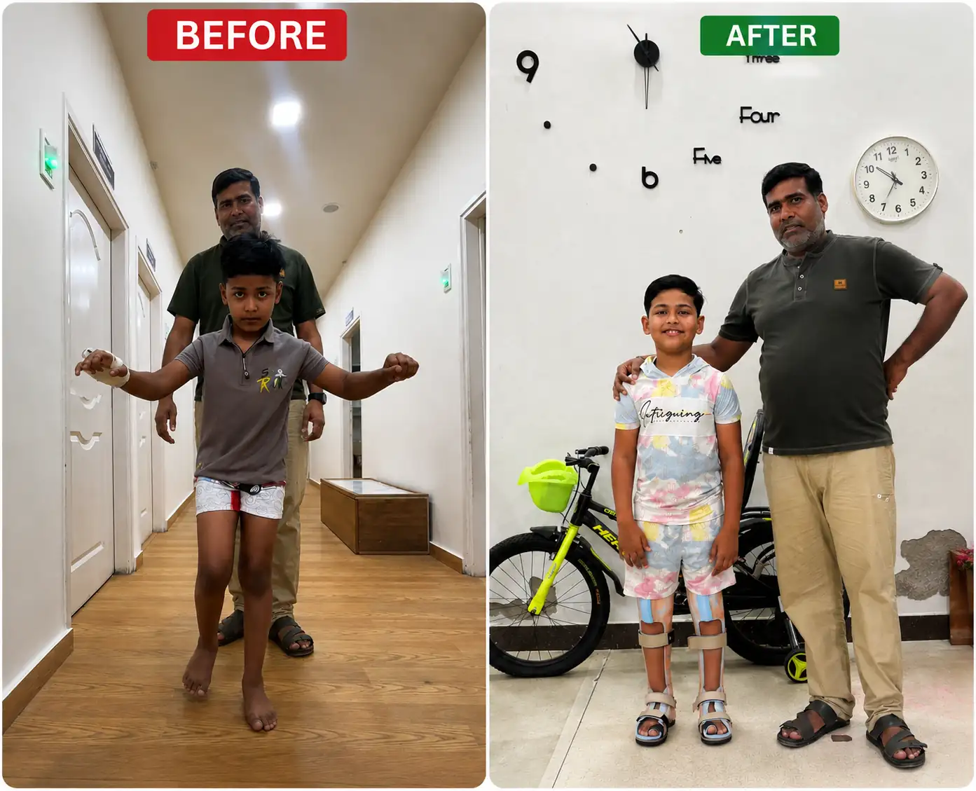 Cerebral Palsy Treatment Before and After Rehabilitation.webp